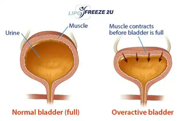 diagram of overactive bladder treatment Portsmouth