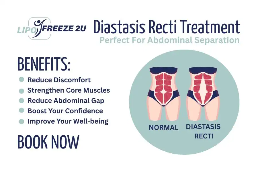 How Long Will It Take to See Improvements in Diastasis Recti Portsmouth