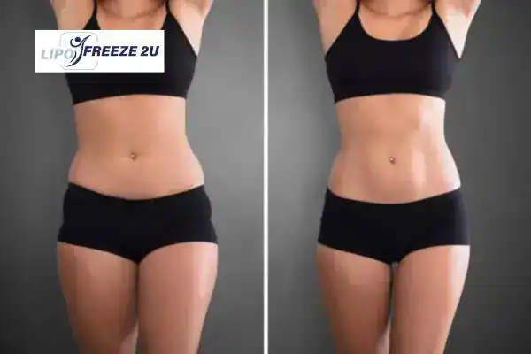 How Can LIPO FREEZE 2U Support Your Post-Pregnancy Body Recovery Portsmouth?