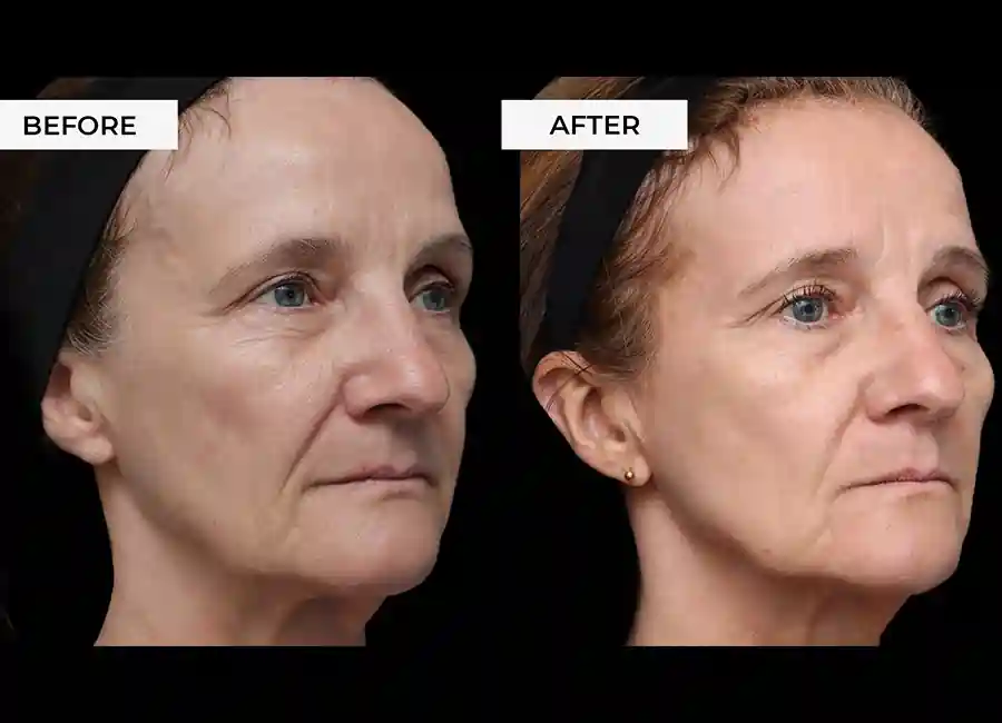 How Many RF Microneedling Sessions Will You Need to See a Difference Portsmouth?
