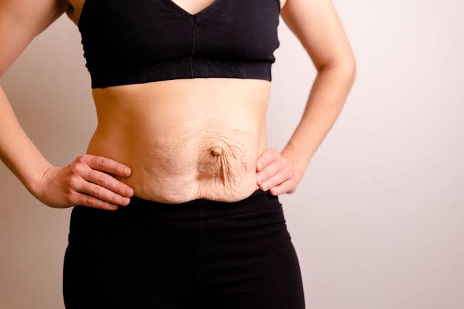 Is Surgery Really the Only Way to Repair Diastasis Recti Portsmouth?