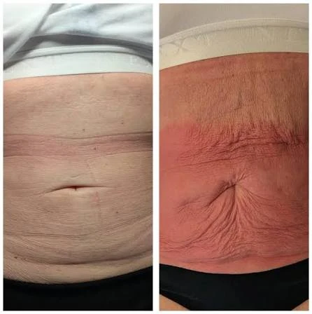 How Does RF Microneedling Improve Crepey, Thin and Uneven Skin Texture Portsmouth?