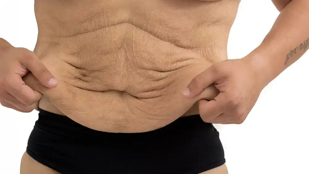 Why Does Weight Loss Medication Leave Some People With Loose or Sagging Skin Portsmouth?